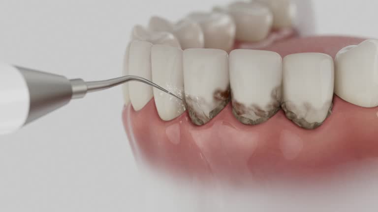 Reliable Tooth Extraction contractor in Lexington, WA by Smile Center Dentistry